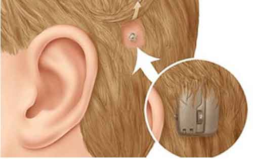 骨导式助听器的运作原理与设计思路