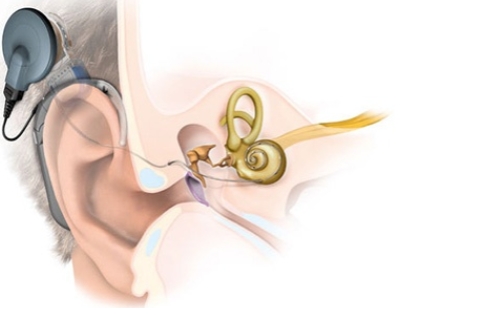 骨传导助听器好用吗 正确认识骨导助听器