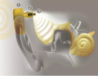 特殊骨传导助听器　