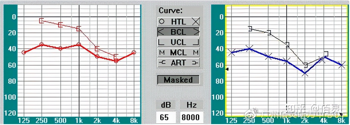 深圳欧维助听器教你轻松看懂纯音听力图（图4）