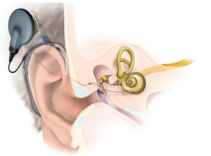 骨传导助听器好用吗 正确认识骨导助听器